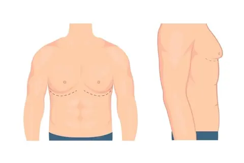 Röpörtaj: Jinekomasti